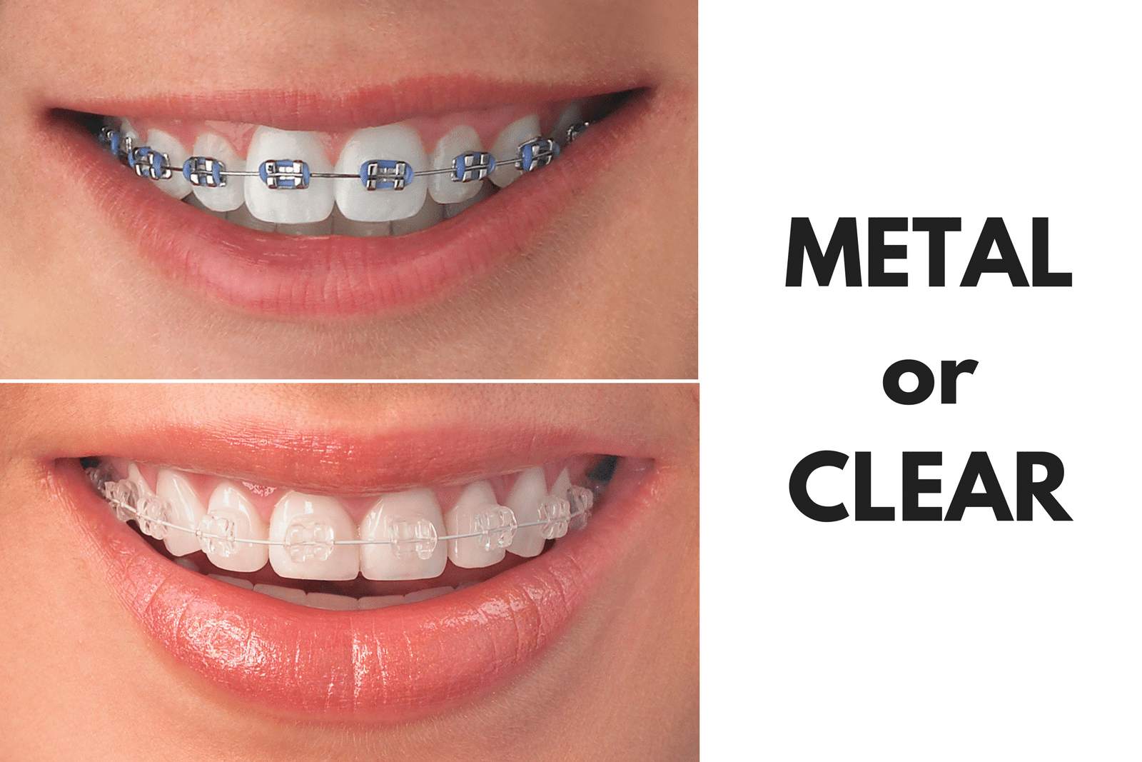 Ask Your Golden Crescent Dentist: Should I Get Metal or Clear Braces?